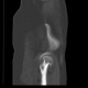 Dysplasia of femoral head: CT - Computed tomography